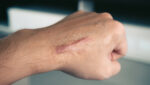 Schmidt Dog Bites that Result in Scarring Are Serious Personal Injury Cases