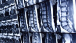 Why do You Need a Personal Injury Attorney for a Soft Tissue Injury?