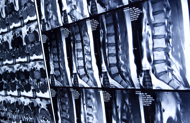 Why do You Need a Personal Injury Attorney for a Soft Tissue Injury?